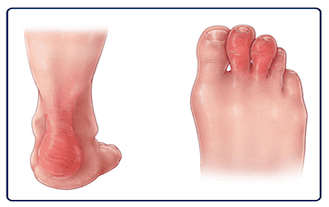 Luskavični (psoriatični) artritis