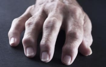 Diagnoza revmatoidnega artritisa